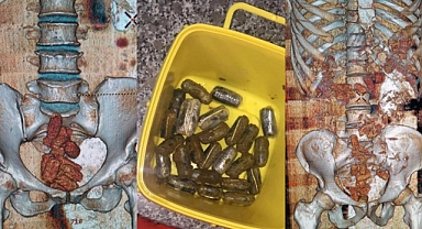 ŞOK OLAY ! MERMİLER BAĞIRSAKLARDA BULUNDU