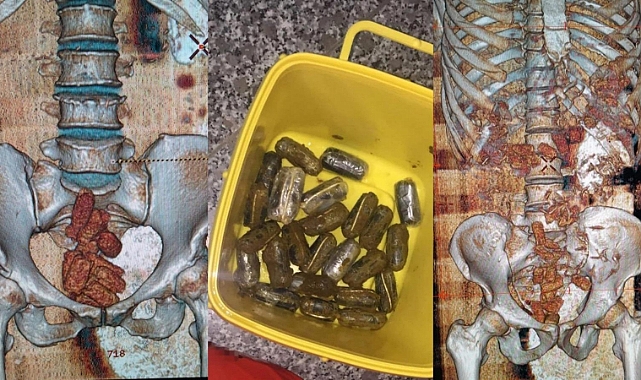 ŞOK OLAY ! MERMİLER BAĞIRSAKLARDA BULUNDU