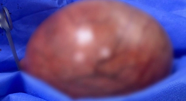 NUMUNE HASTANESİNDE BİR BAŞARILI OPERASYON DAHA