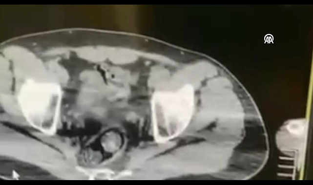 BU KADARINA PES... BAĞIRSAKLARINDAN ZEHİR ÇIKTI!