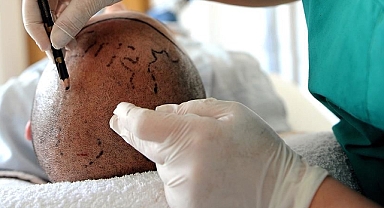 SAÇ EKİMİ CAN ALDI... O İŞLETMEYE SORUŞTURMA!